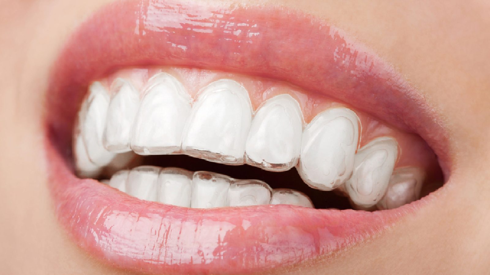 Invisalign (Şeffaf Plak)