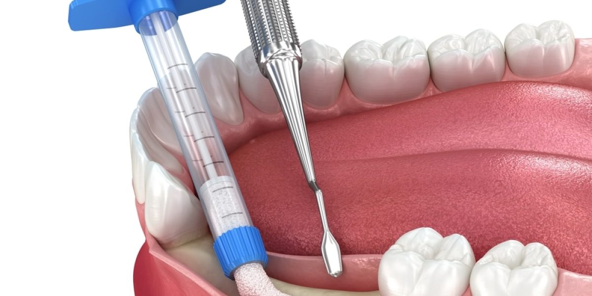 Bone,Grafting,,Augmentation.,Medically,Accurate,3d,Illustration.